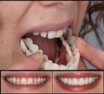 Snap On Smile Comfort Fit Flex Cosmetic Combo Teeth - Image 4